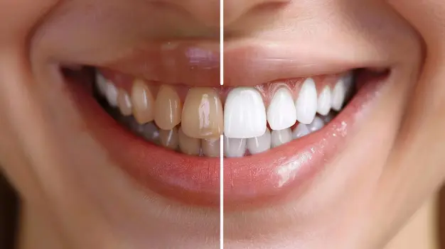 blanqueamiento dental Ecuador Odontología Life