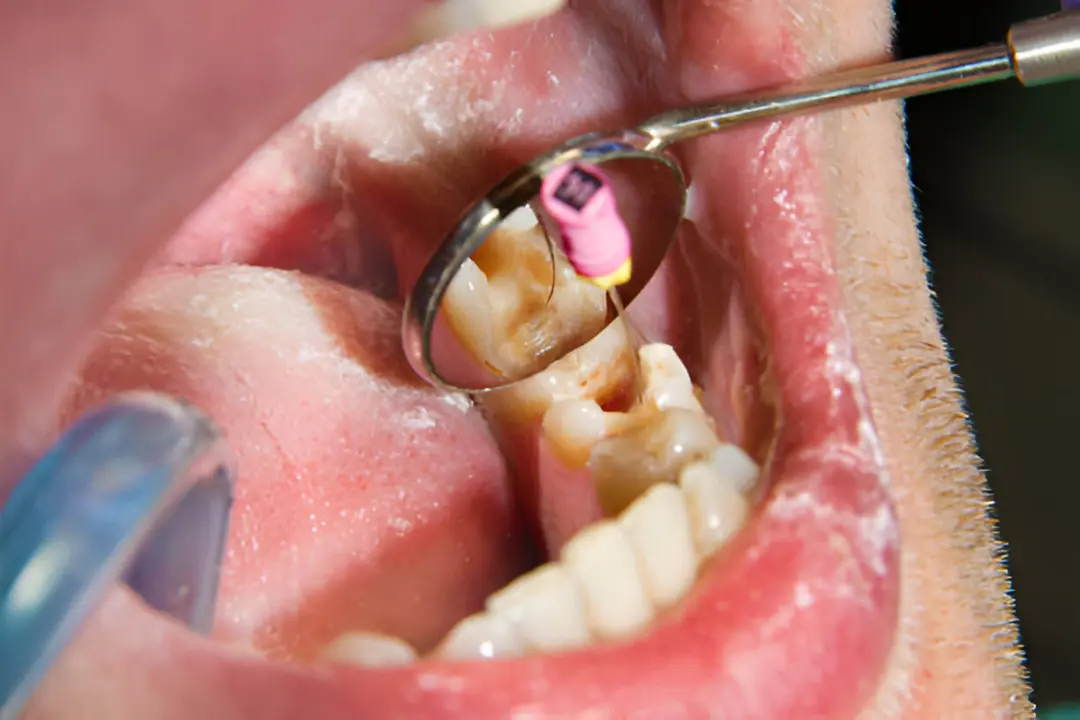 ¿Duele una endodoncia? Consulta profesional