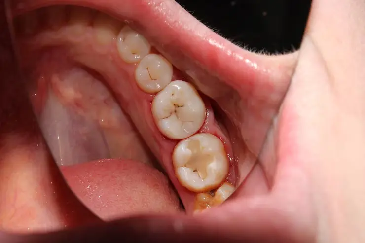 Enfermedades por no asistir al dentista