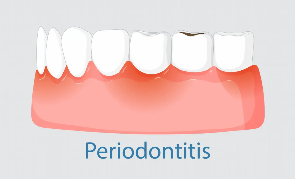 Vista de la enfermedad periodontitis con las encías hinchadas y diente afectado