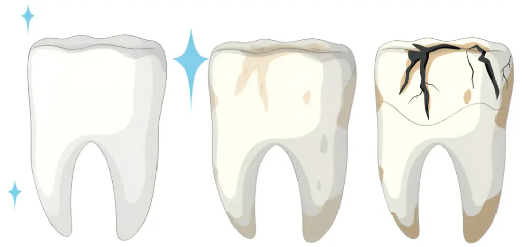 efectos del piercing en la lengua y labios desgaste de esmalte