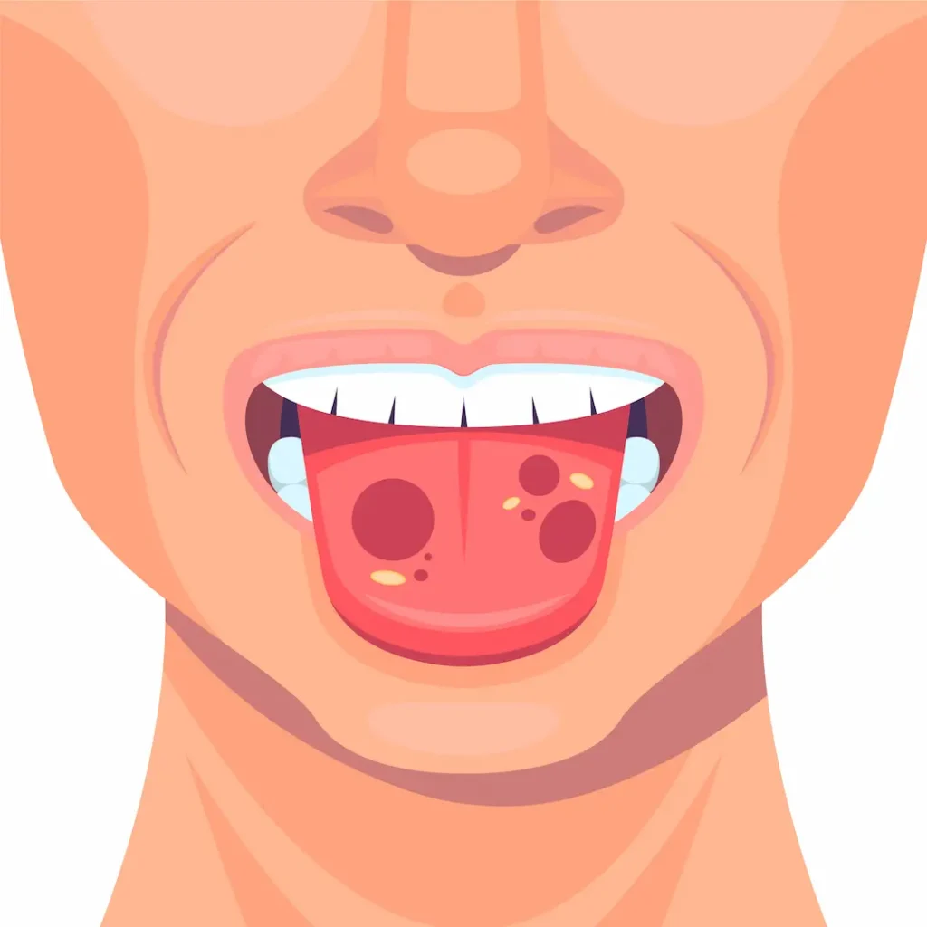 efectos del piercing en la lengua y labios