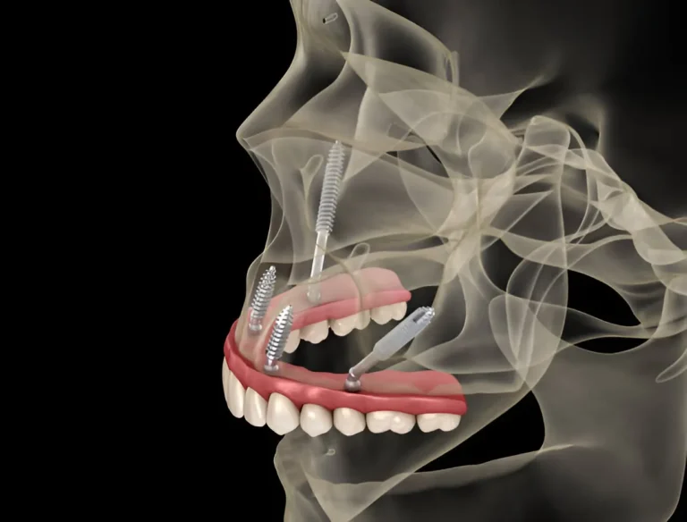 implantes cigomáticos