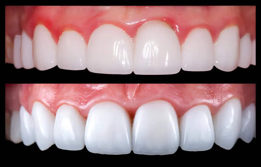 recontorneo estético de encías procedimiento