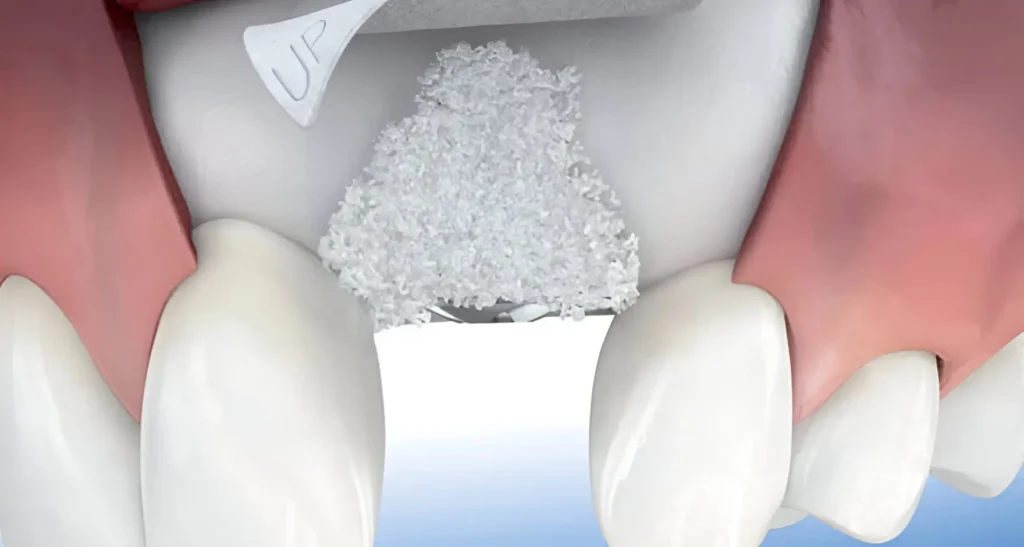 regeneración ósea guiada