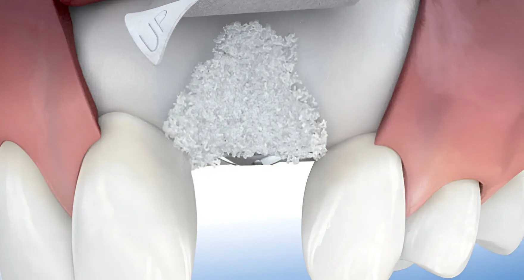 regeneración ósea guiada