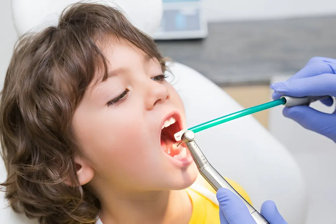Proceso de aplicación de sellantes dentales en niños