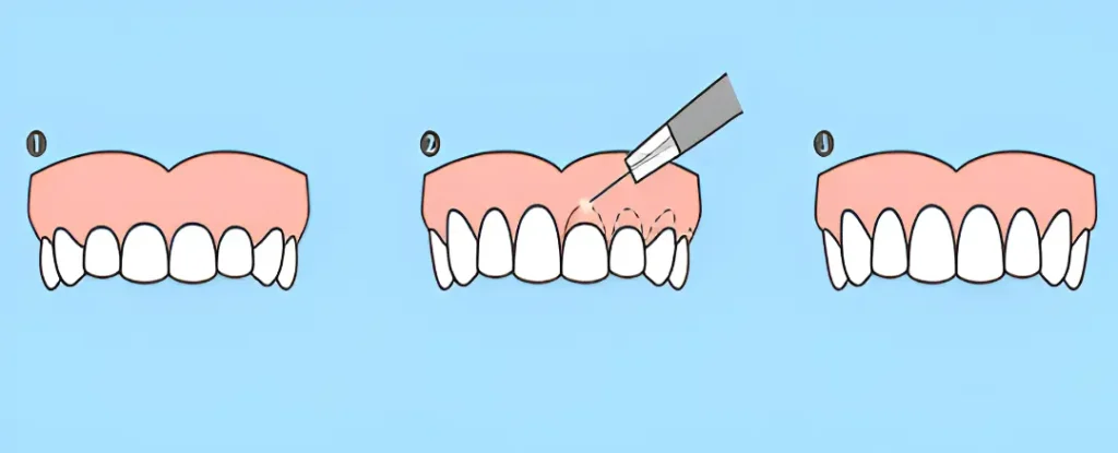 sonrisa armónica recontorneo estético de encías