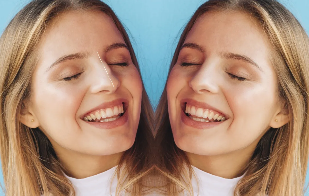 Carillas dentales antes y después - resultado del diseño de sonrisa en Ecuador