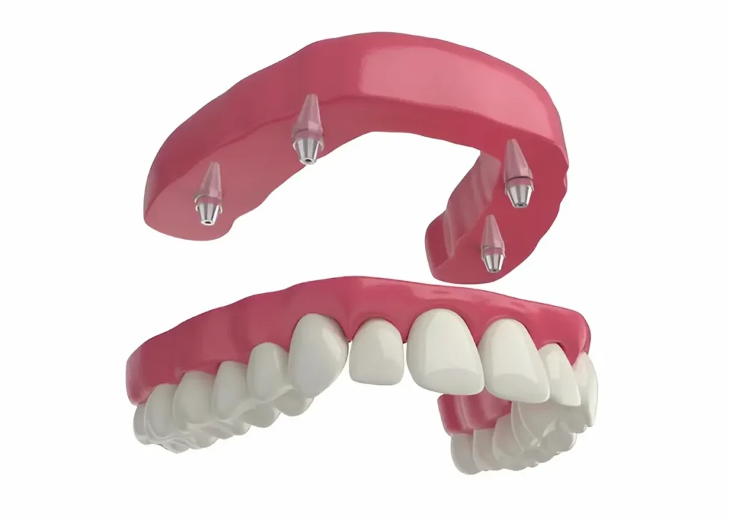 Prótesis dental fija instalada para restaurar la sonrisa de un paciente en Odontología Life