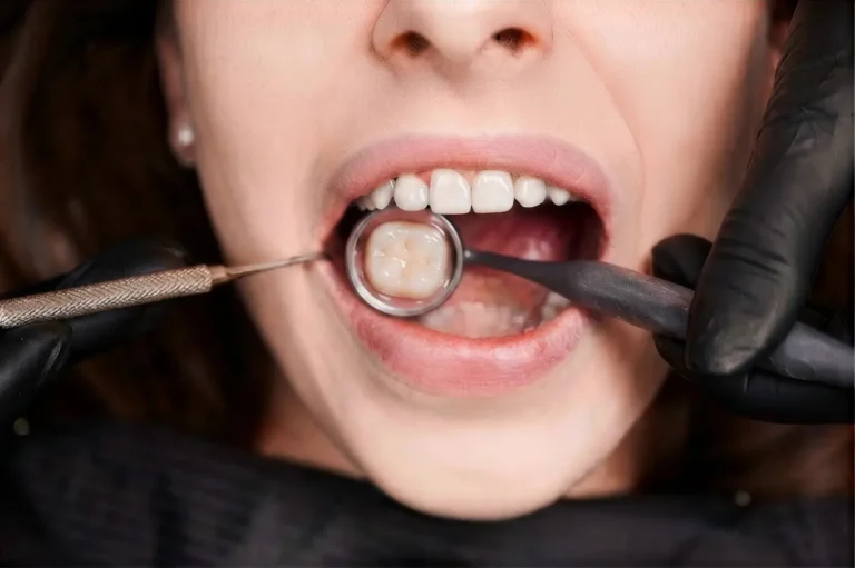 Calza dental para restaurar un diente con caries