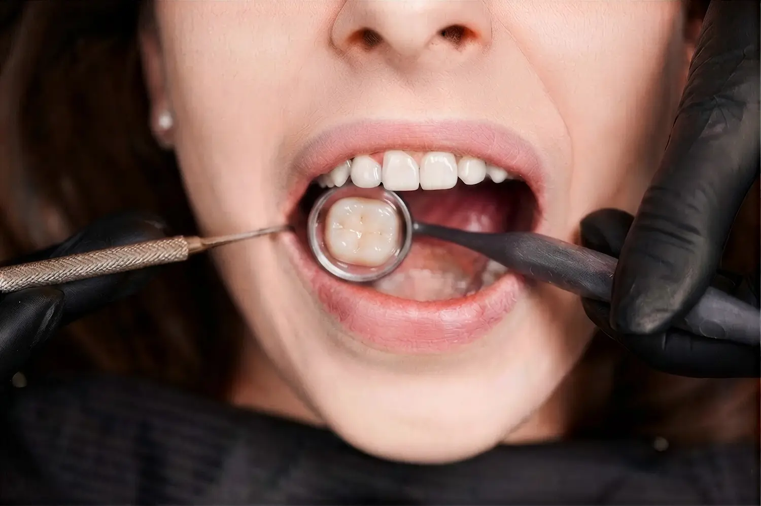 Calza dental para restaurar un diente con caries