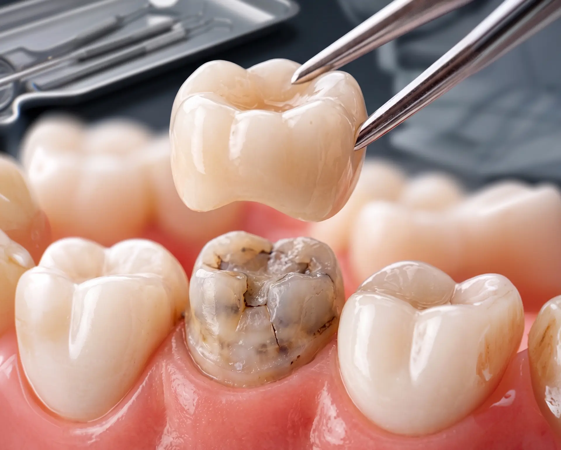 Corona dental para proteger y restaurar un diente dañado
