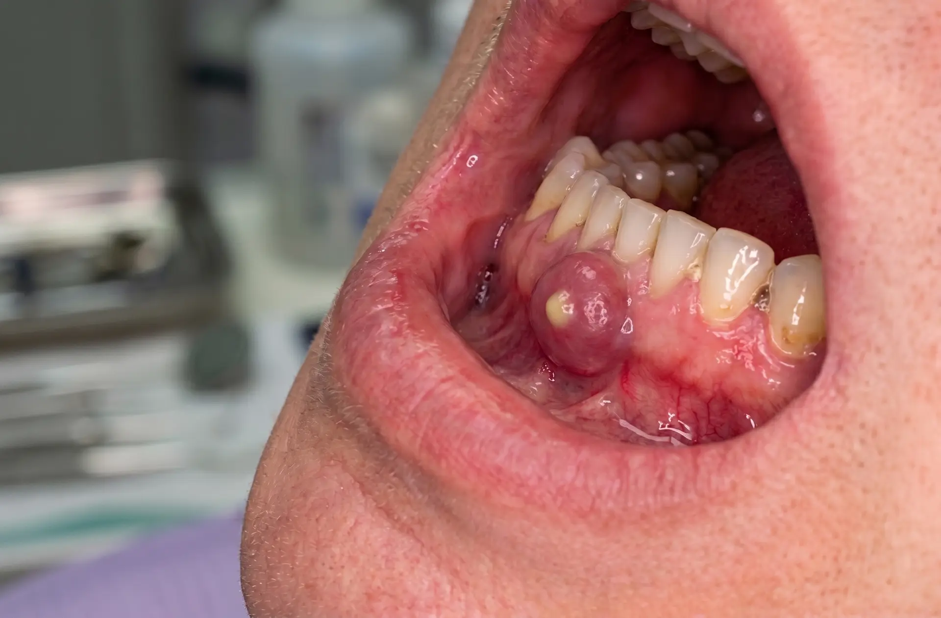 Flemón dental con inflamación en la encía y rostro
