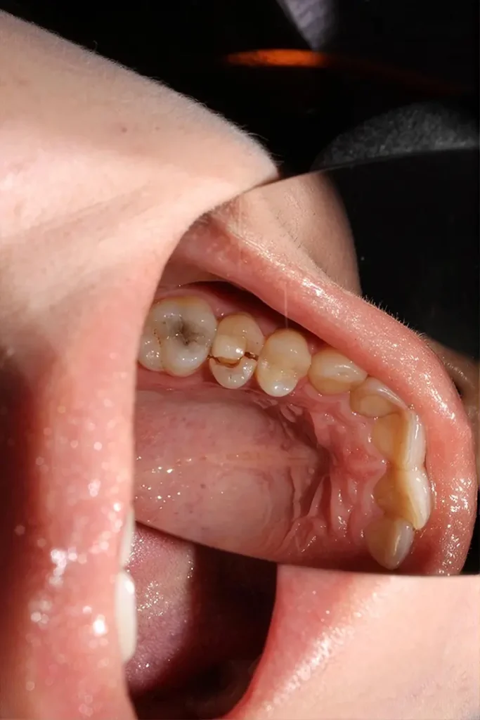 Muela del juicio relacionada con flemón e inflamación dental