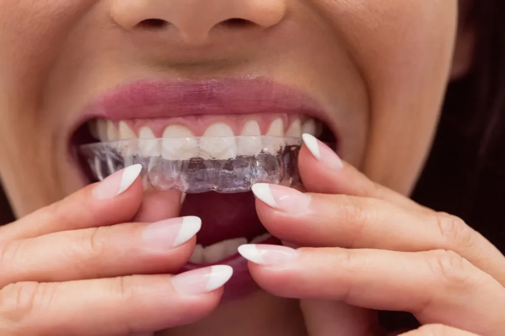 Retenedores dentales para mantener los dientes después de ortodoncia