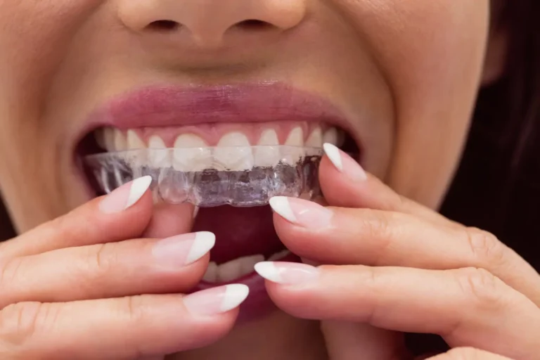 Retenedores dentales para mantener los dientes después de ortodoncia