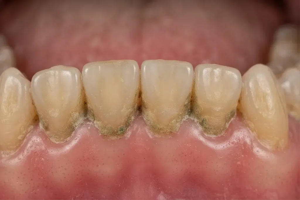 Sarro dental relacionado con mal aliento y problemas bucales