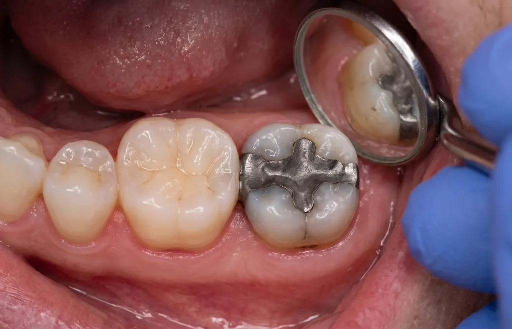 Amalgama como calza dental para restaurar una muela afectada por caries