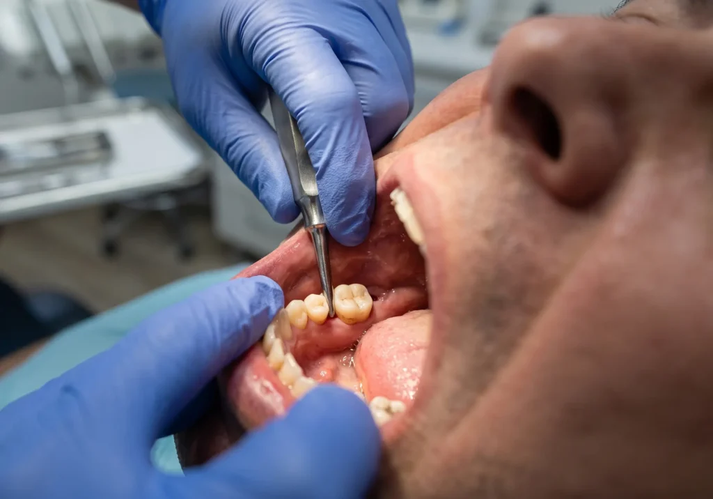 Extracción dental simple mediante luxación controlada de una pieza dental