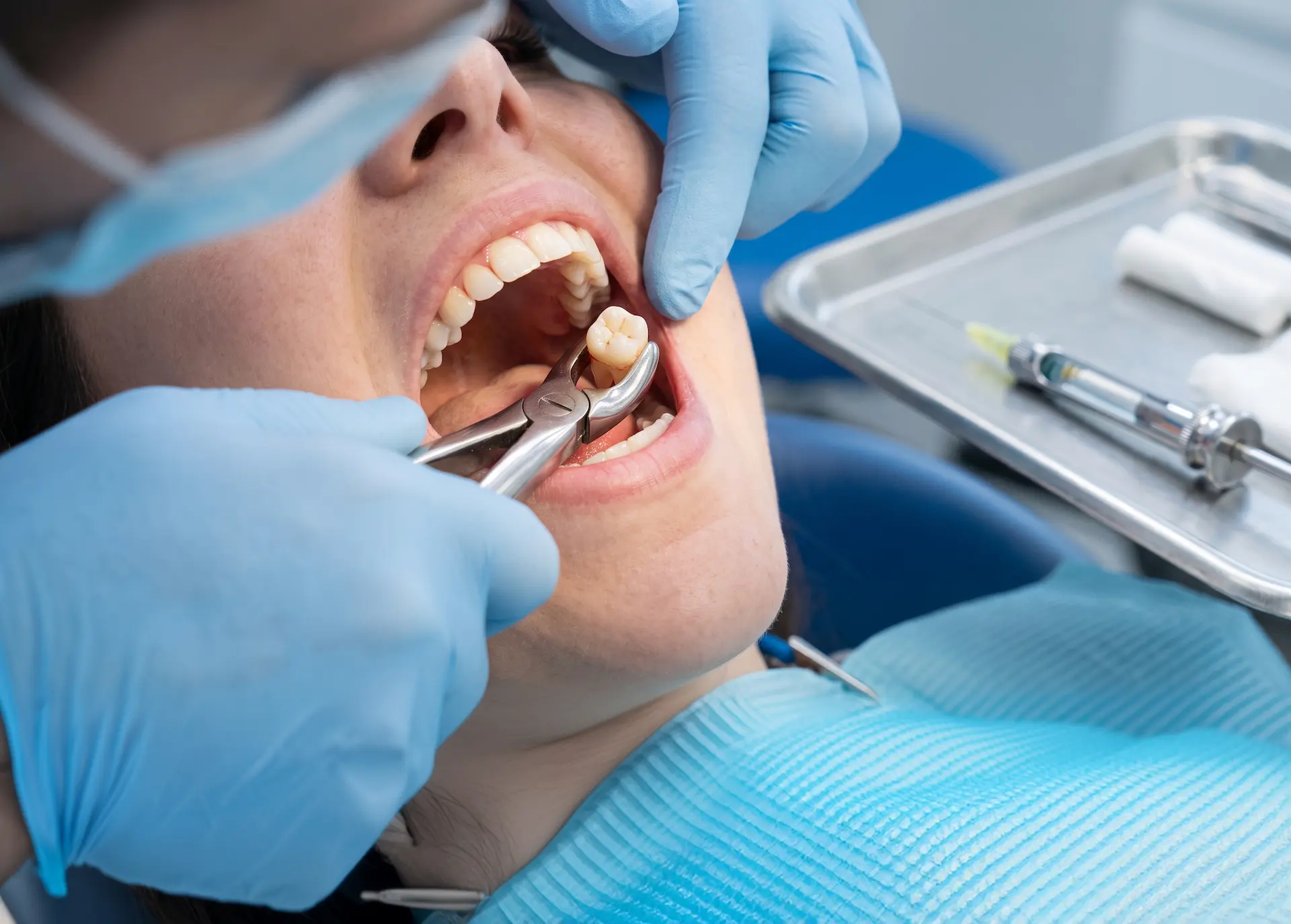 Extracción dental simple para retirar un diente afectado de forma segura