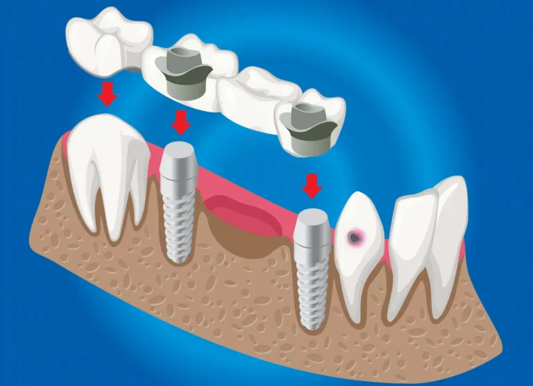 Implante dental o puente fijo para reemplazar un diente perdido
